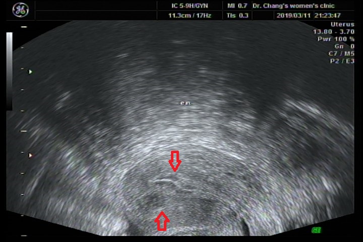 張帆婦產科｜圖：只有一公分多的肌瘤，但卻把子宮內膜壓彎了