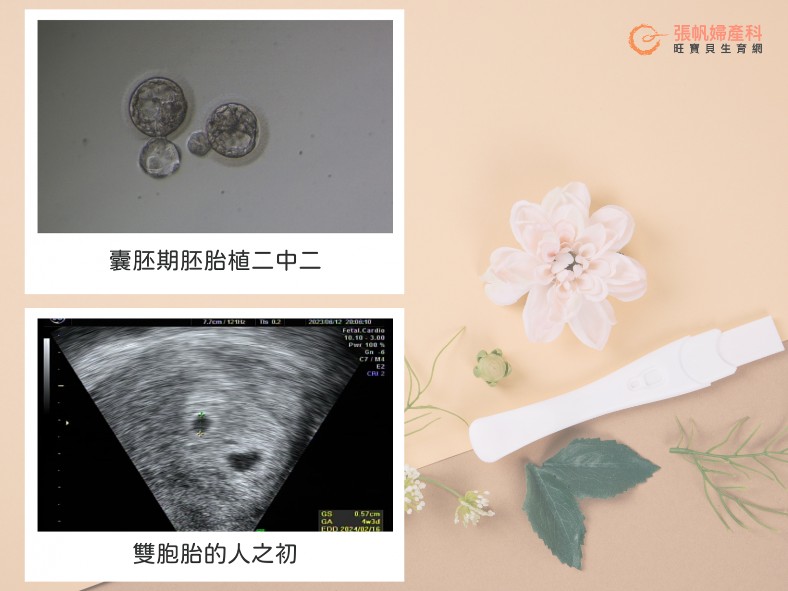 張帆婦產科｜「養集卵」後一次達成6囊胚！冷刀處理內膜水瘤後植二中二