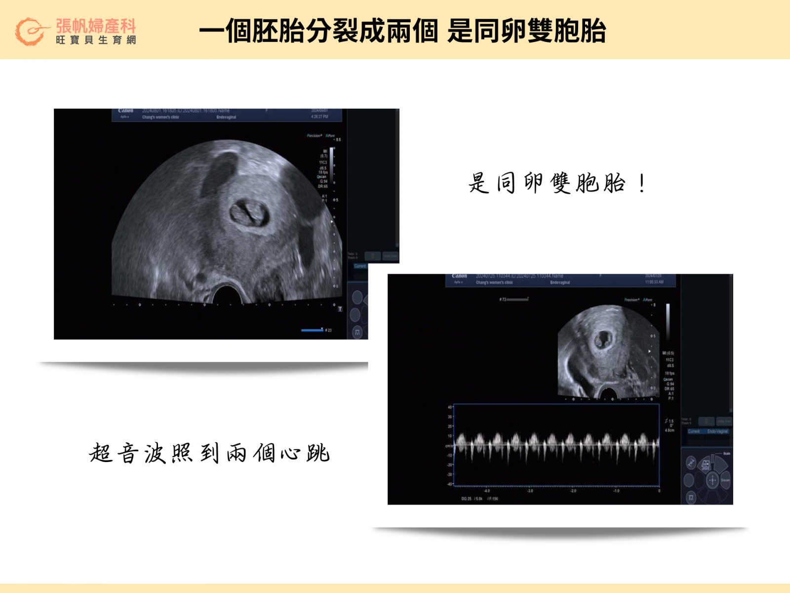 張帆婦產科｜一個胚胎分裂成兩個 是同卵雙胞胎