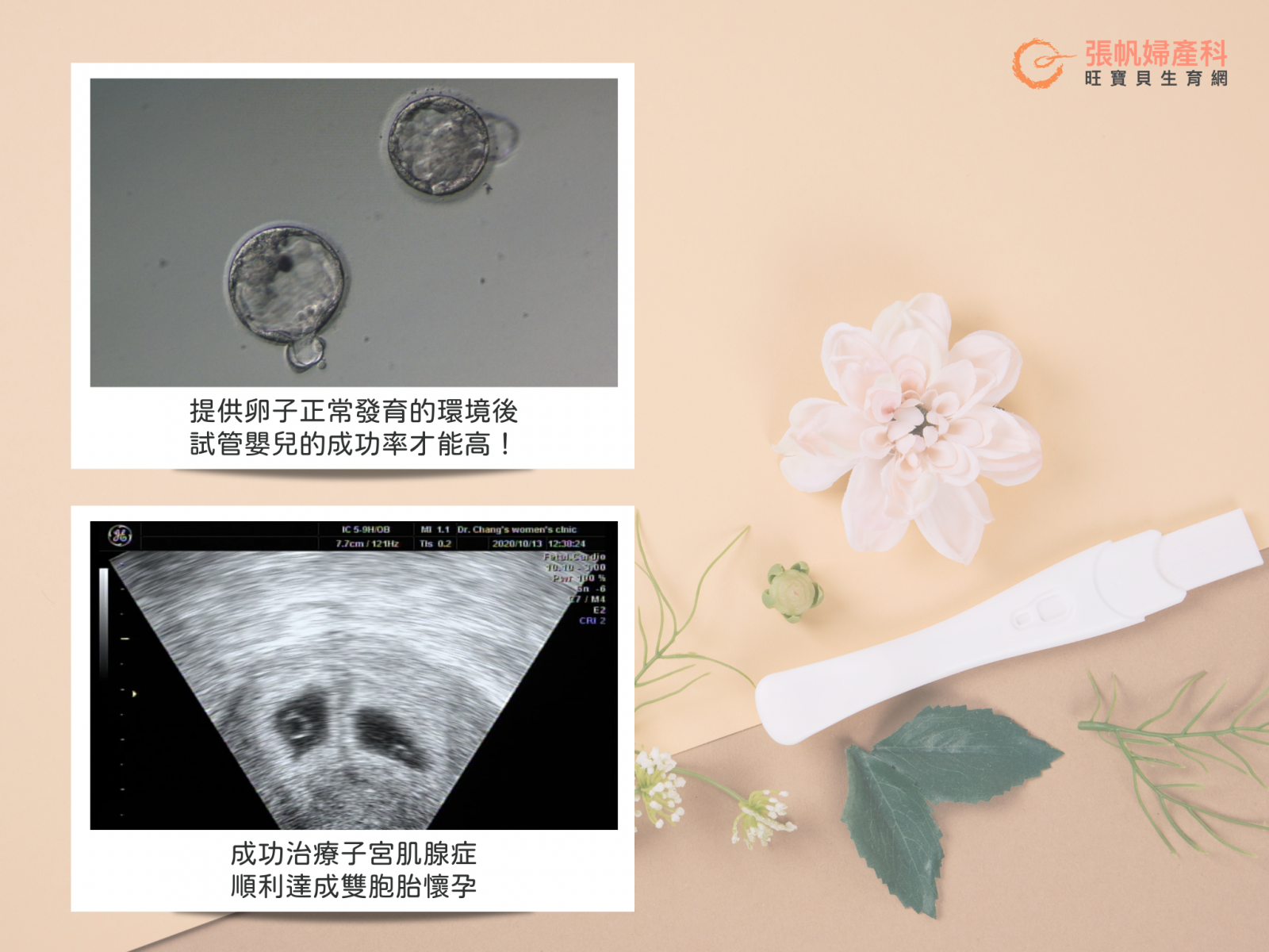 張帆婦產科｜合併子宮肌腺症手術和試管嬰兒治療不孕症成功案例