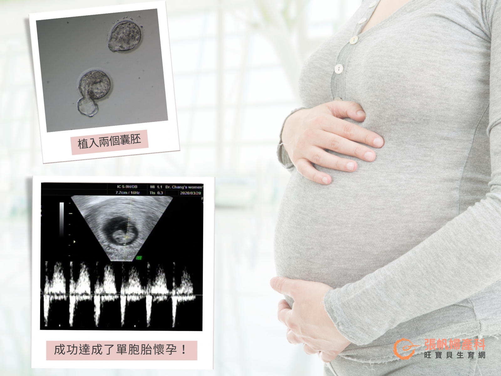張帆婦產科｜40歲的她經歷了內膜的培養 植入兩個囊胚後成功懷孕