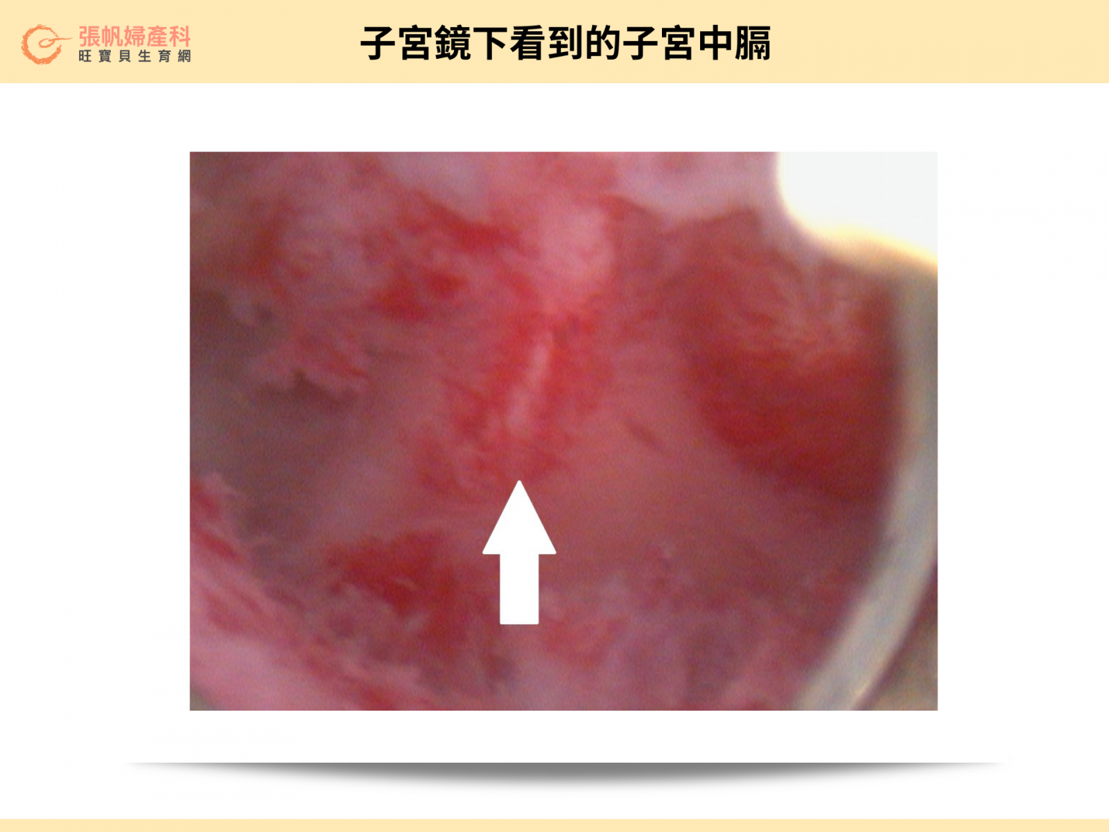 張帆婦產科｜子宮鏡下所看到的子宮中膈