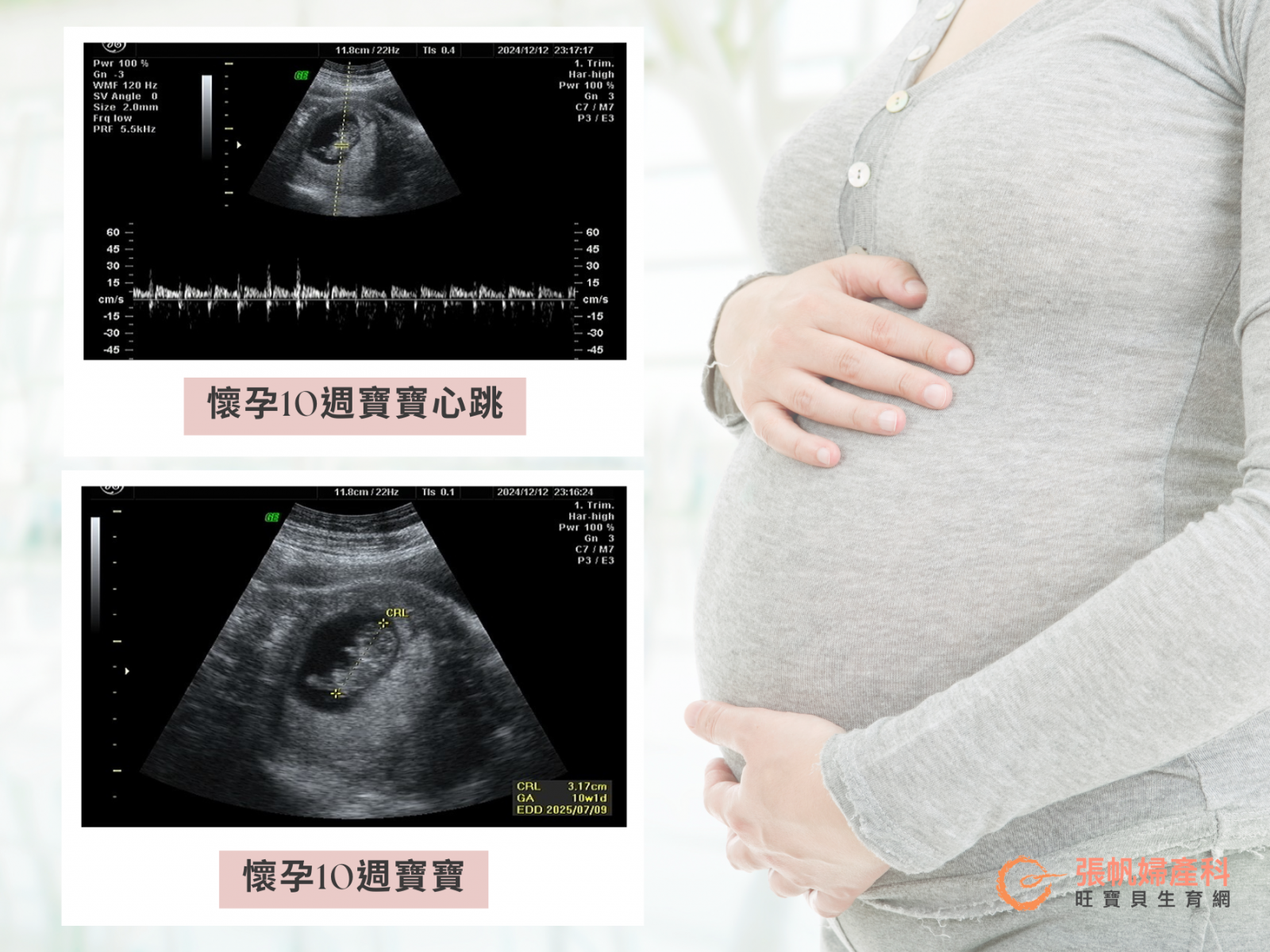 張帆婦產科｜懷孕10週寶寶