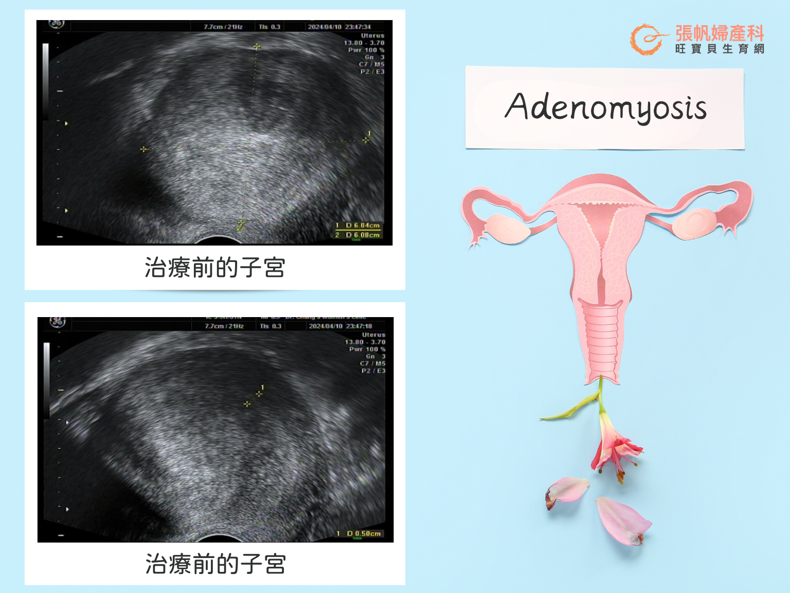 張帆婦產科｜35歲子宮肌腺症患者