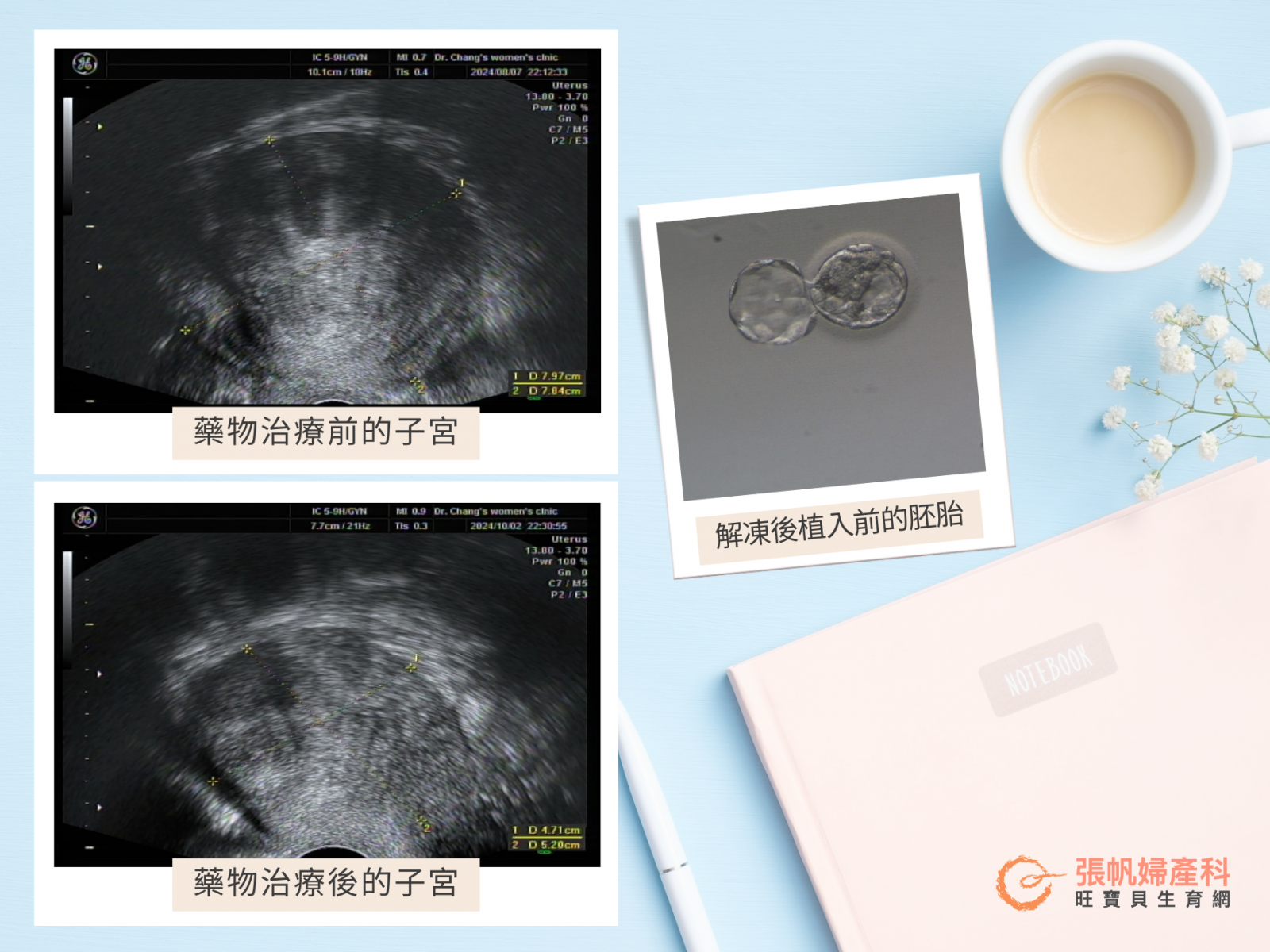 張帆婦產科｜藥物治療前後的子宮與胚胎