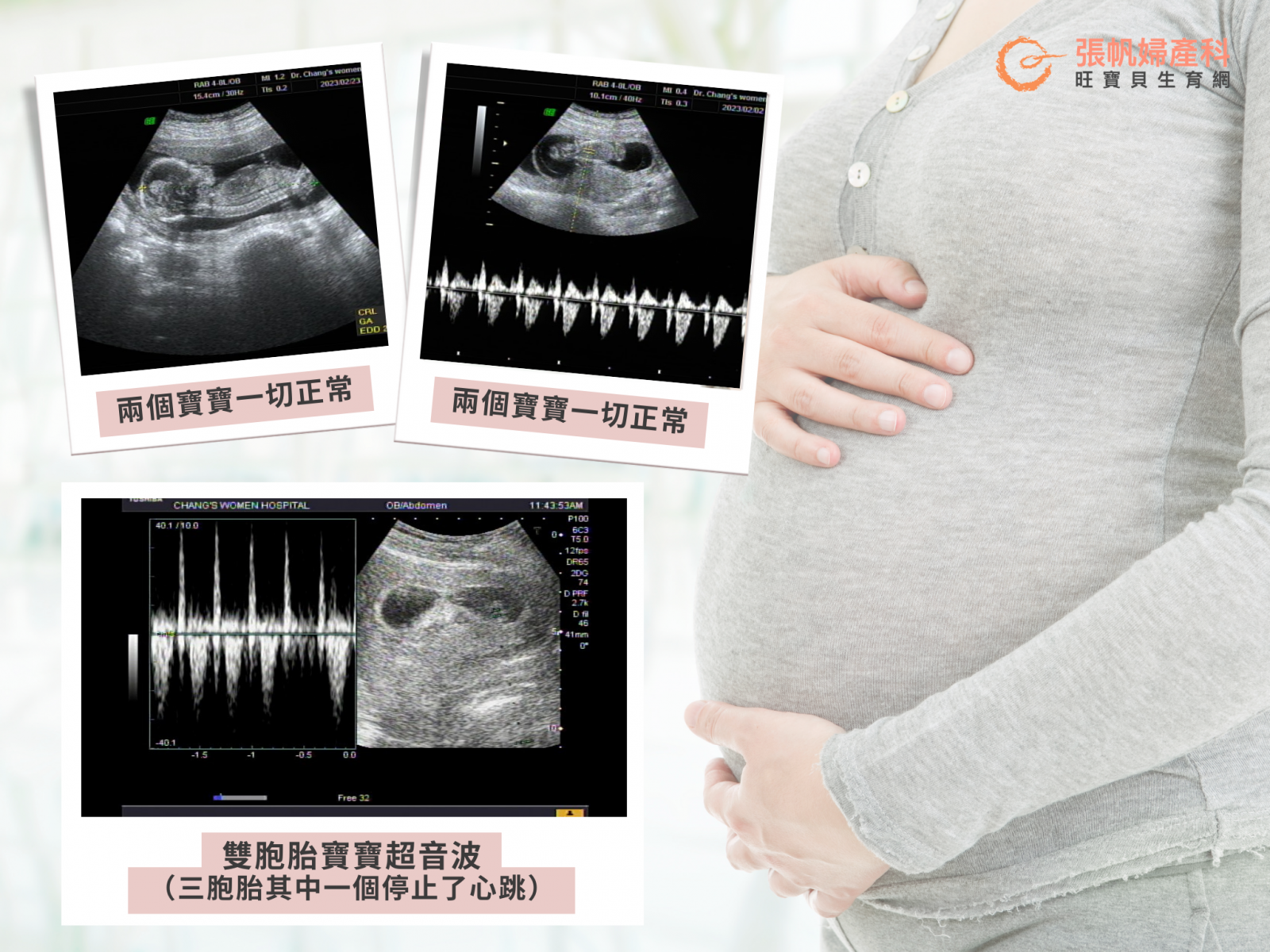 張帆婦產科｜戰勝難纏子宮內膜異位症：病人已做完羊膜穿刺，兩個寶寶完全正常，現在已轉出，前往醫學中心待產了！