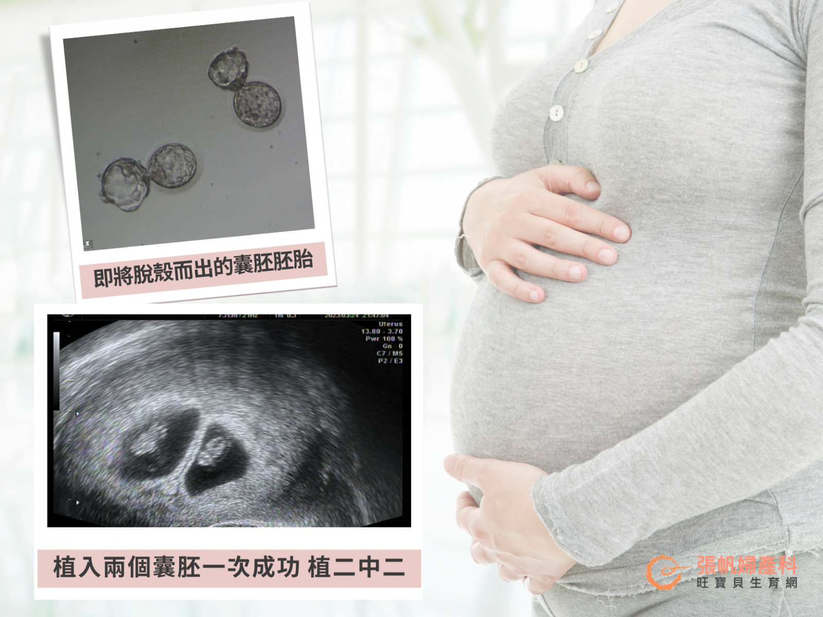 張帆婦產科｜第一次療程就植二中二 靠調整卵子履歷避免失敗嘗試