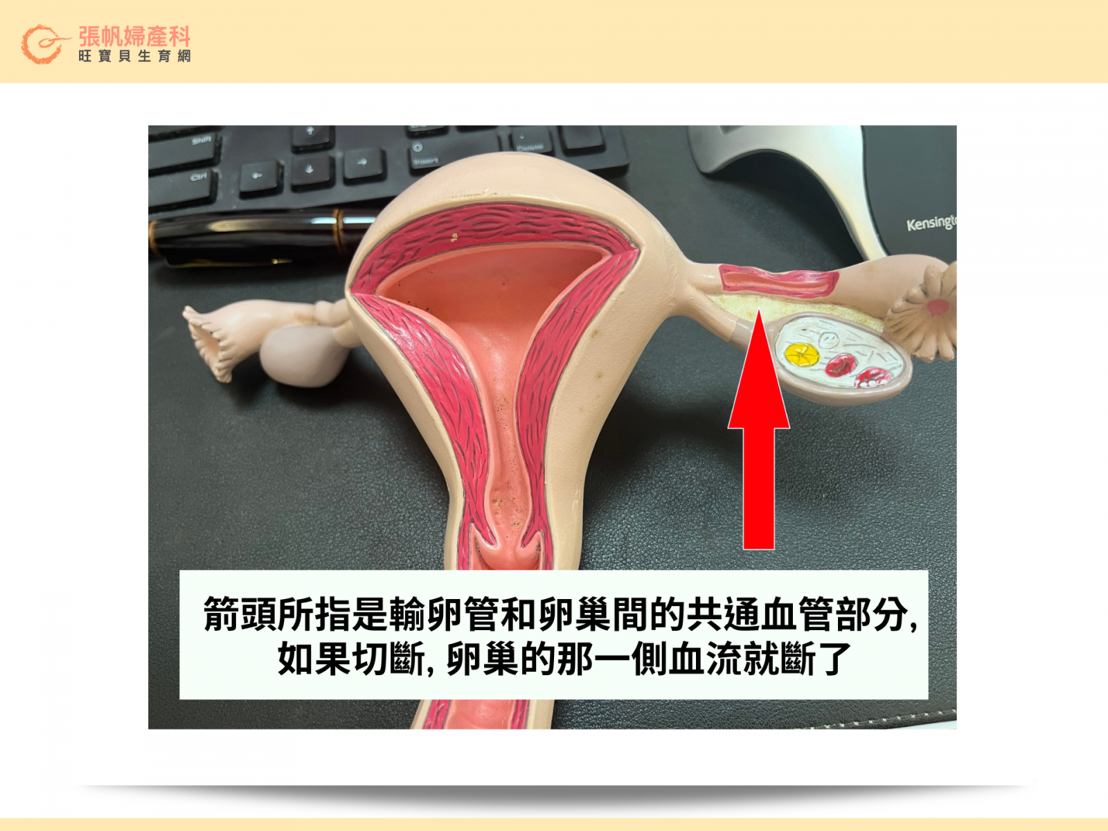 張帆婦產科｜箭頭所指是輸卵管和卵巢間的共通血管部分, 如果切斷, 卵巢的那一側血流就斷了