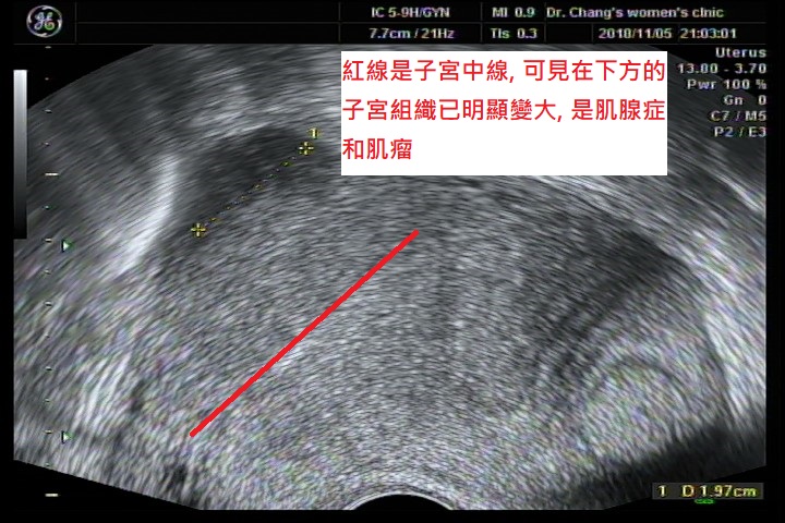 有肌腺症和肌瘤，卵巢有巧克力囊腫