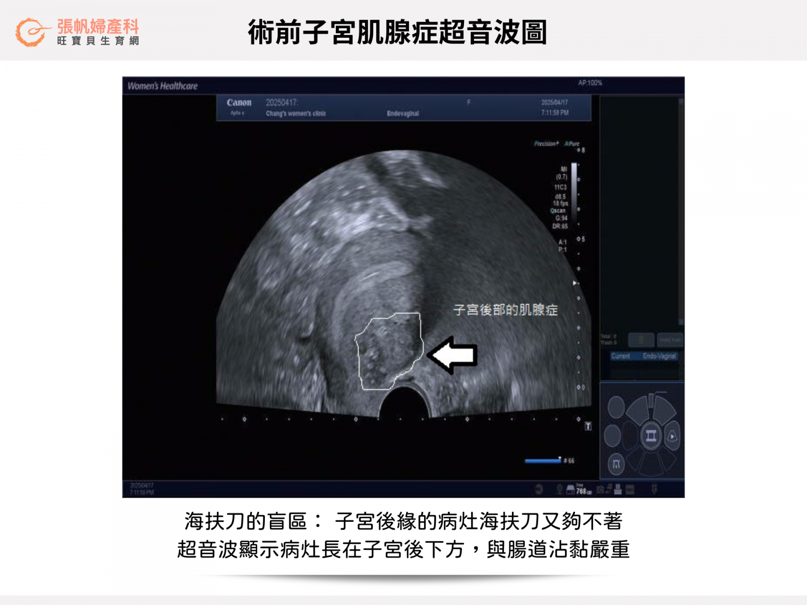 張帆婦產科｜海扶刀的盲區： 子宮後緣的病灶海扶刀又夠不著