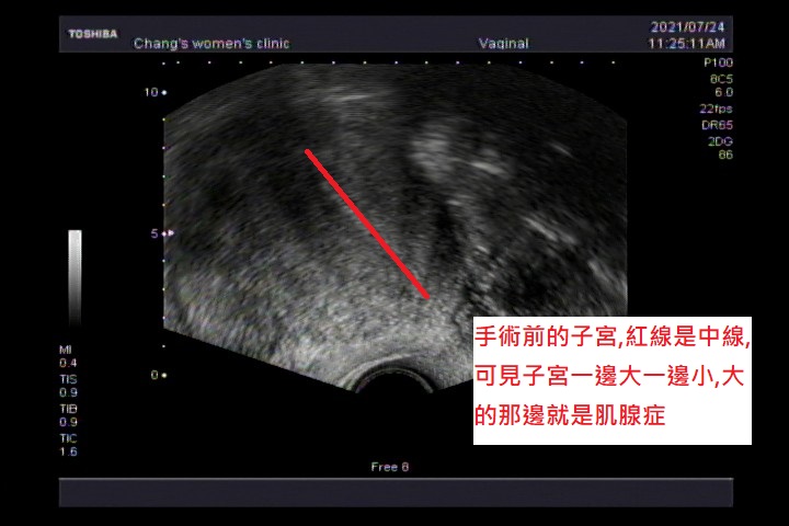 什麼是子宮肌腺症？