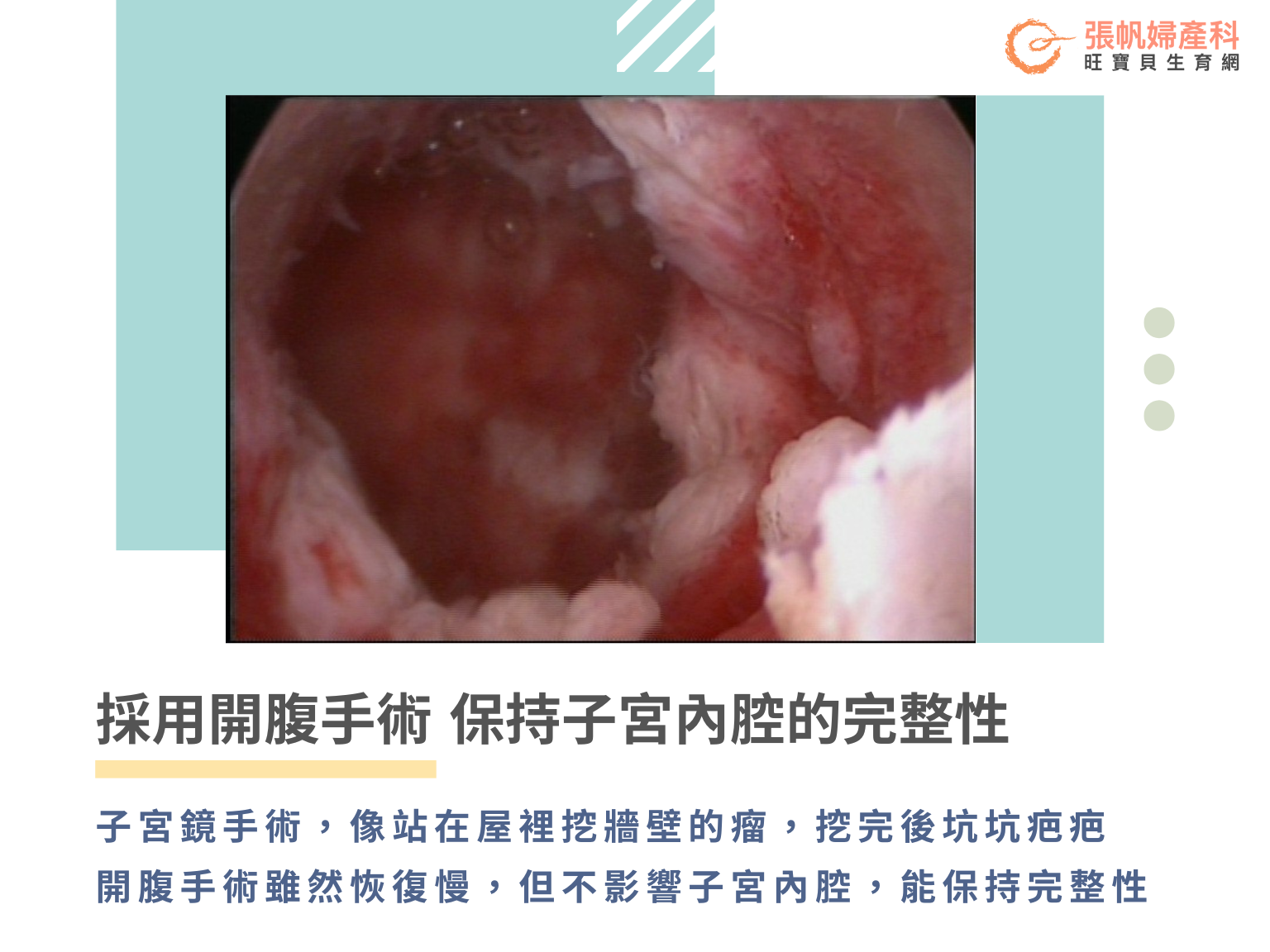 張帆婦產科｜採用開腹手術 保持子宮內腔的完整性