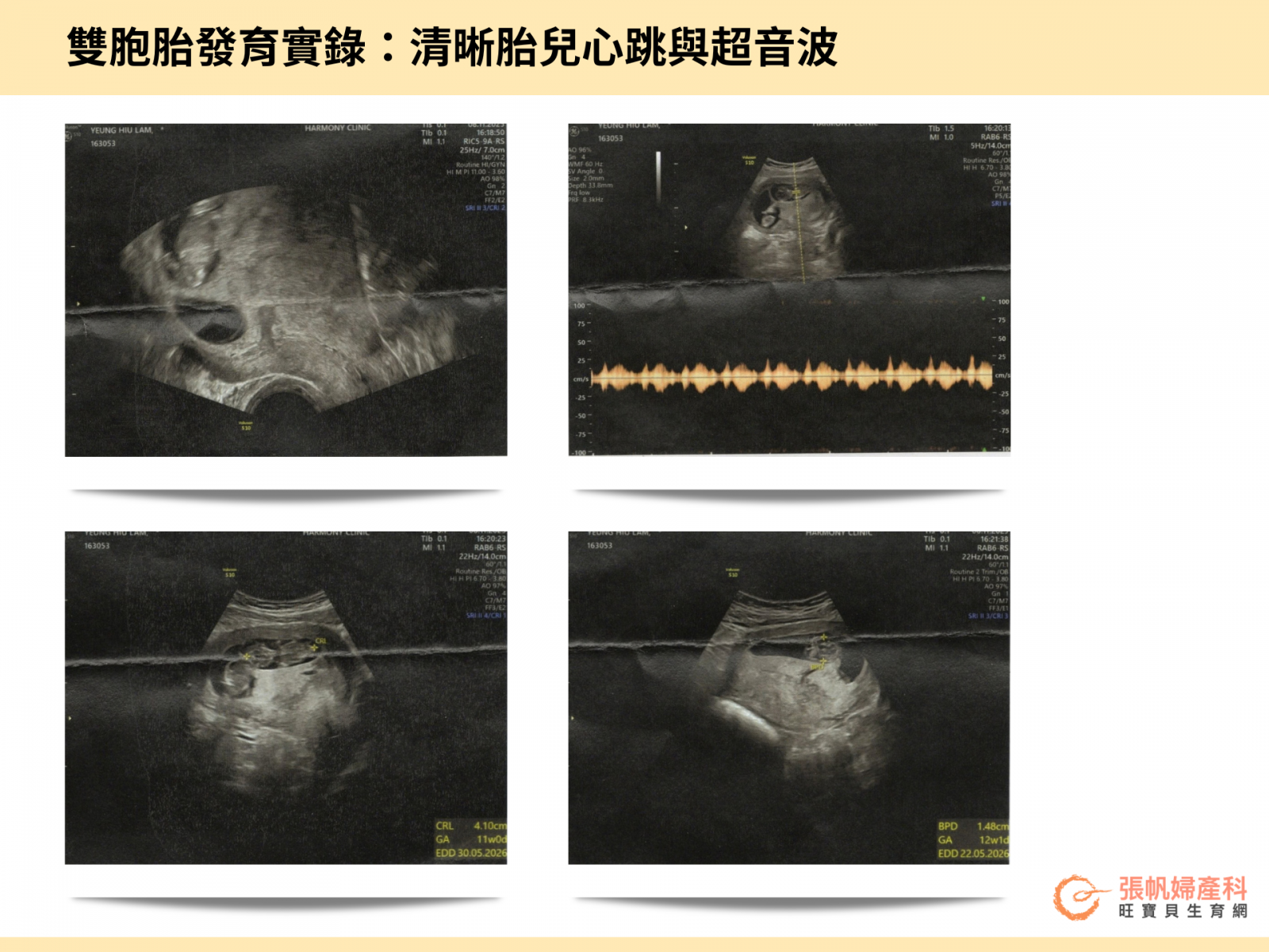 張帆婦產科｜雙胞胎發育實錄：清晰胎兒心跳與超音波