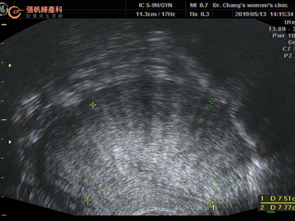 【張帆婦產科】成功案例：高齡肌腺症