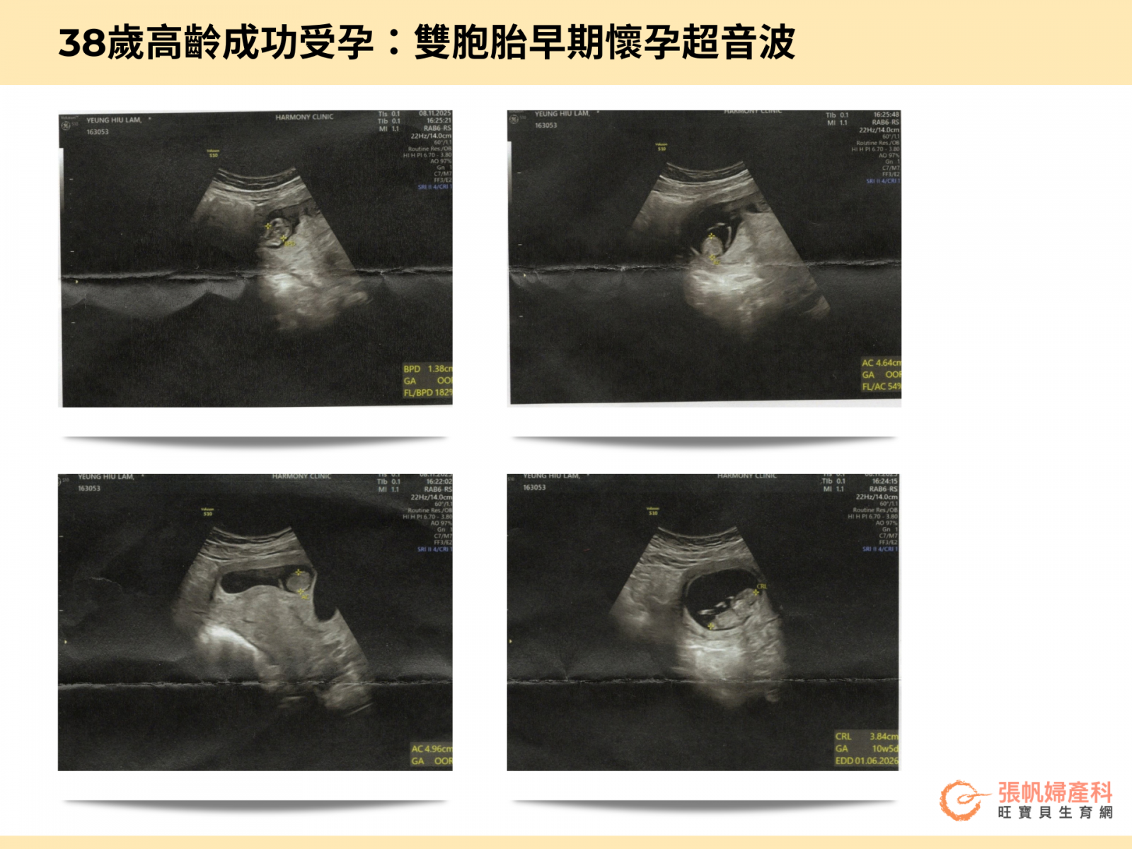 張帆婦產科｜38歲高齡成功受孕：雙胞胎早期懷孕超音波