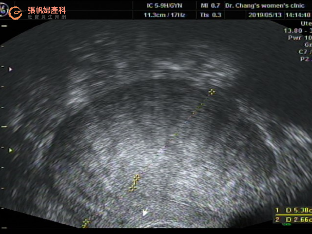 【張帆婦產科】成功案例：高齡肌腺症