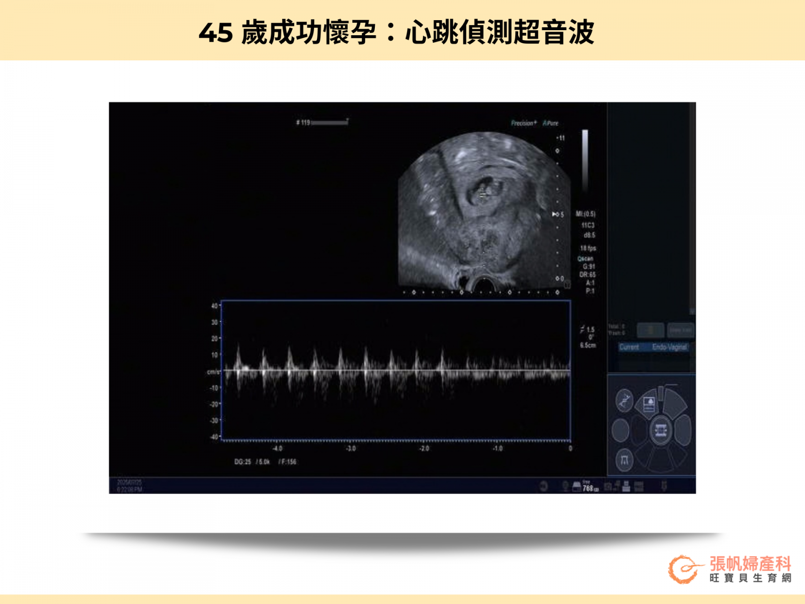 張帆婦產科|45 歲成功懷孕:心跳偵測超音波