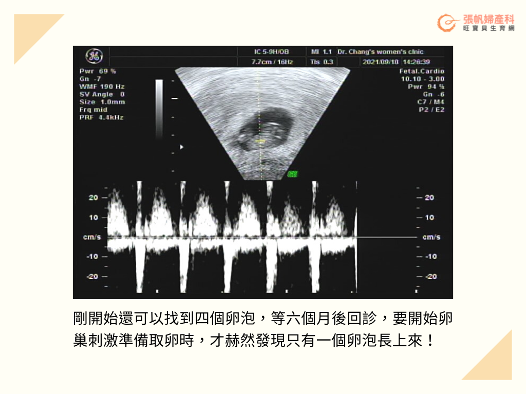 要開始卵巢刺激準備取卵時，才赫然發現只有一個卵泡長上來