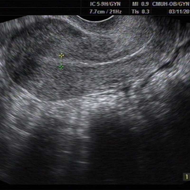 子宮內膜的治療的秘密,連續兩年試管嬰兒零子宮外孕-張帆婦產科
