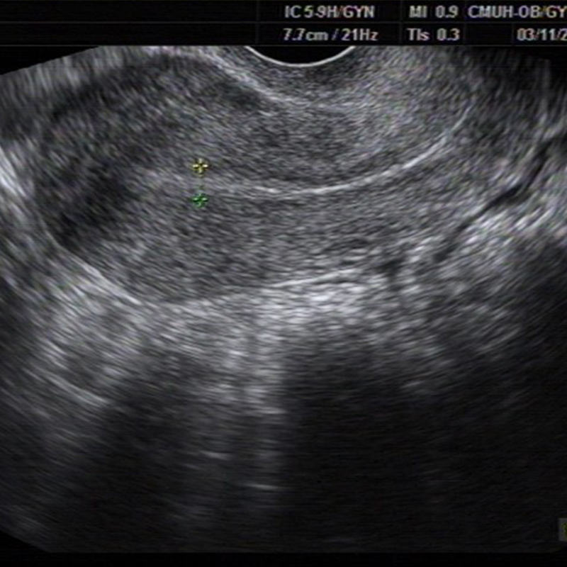 忙碌充實的一天,子宮內膜0.4-0.6公分的媽媽終於生了-張帆婦產科