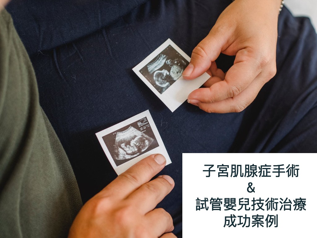 【張帆婦產科】成功案例：子宮肌腺症手術合併試管嬰兒技術治療