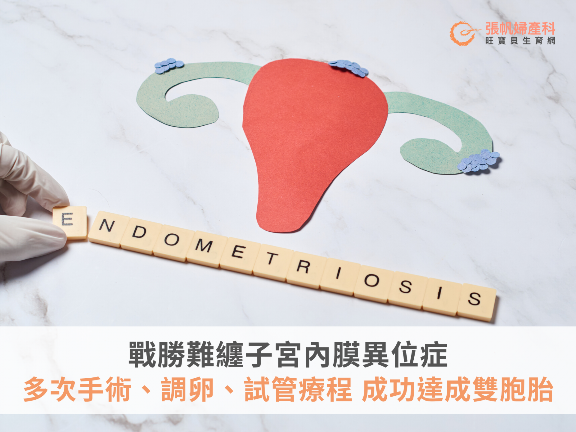 戰勝難纏子宮內膜異位症，多次手術、調卵及試管療程後，成功達成雙胞胎| 張帆婦產科
